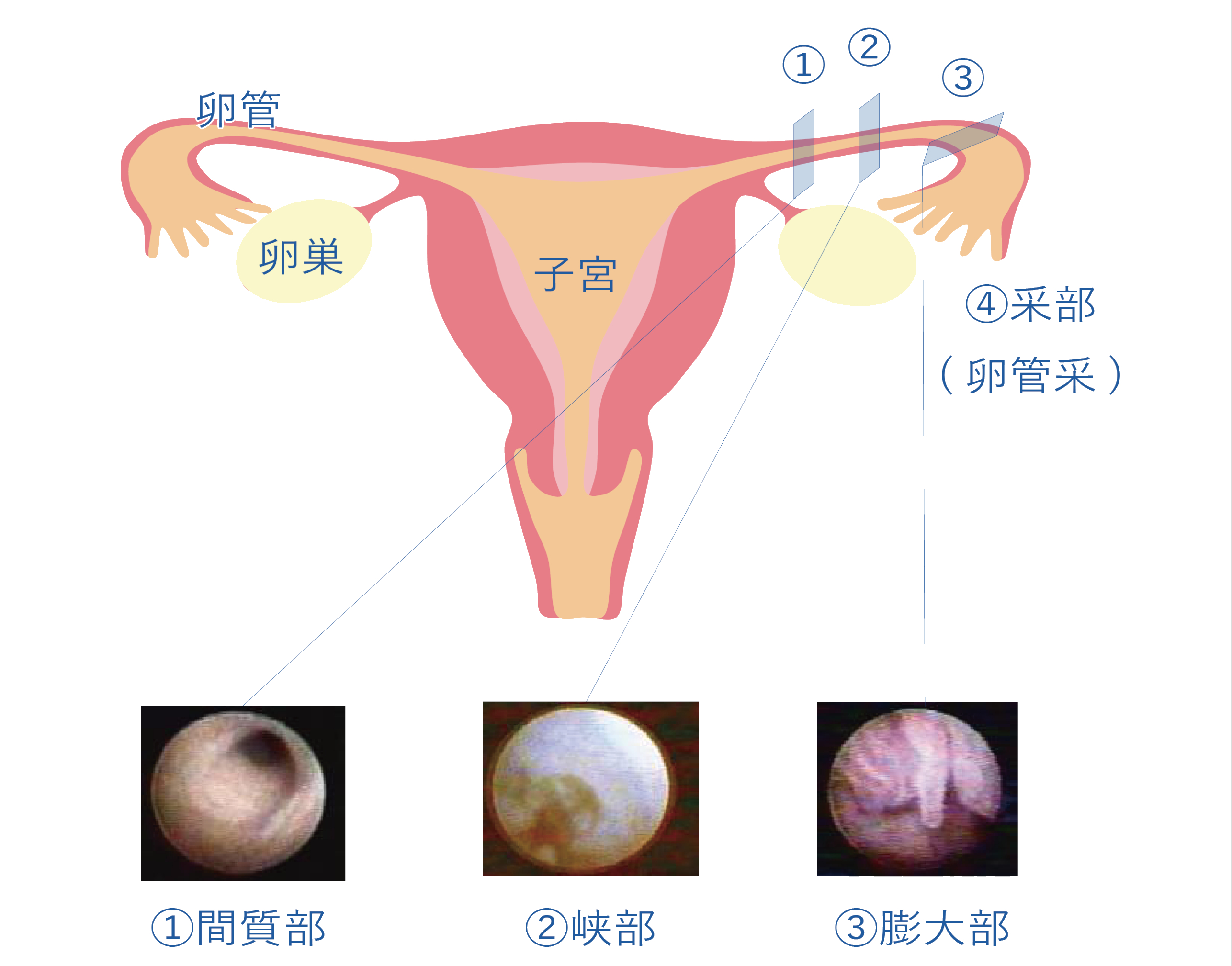 卵 管 造影 検査